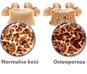 osteoporoza